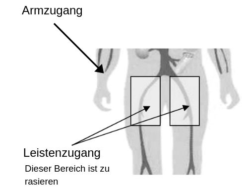 Herzkatheteruntersuchung Wien - Coronographie- Angiographie - ITC Wien